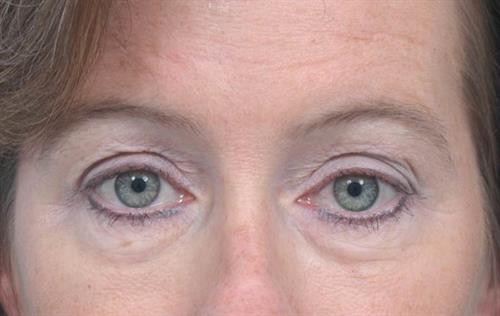 Eyelid Surgery Before Photo | Miami, FL | Baker Plastic Surgery