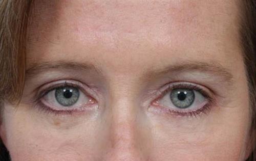 Eyelid Surgery After Photo | Miami, FL | Baker Plastic Surgery