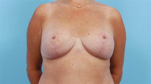 Breast Reduction After Photo | Miami, FL | Baker Plastic Surgery