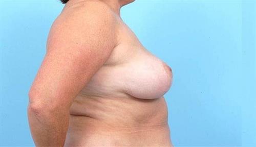 Breast Reduction After Photo | Miami, FL | Baker Plastic Surgery