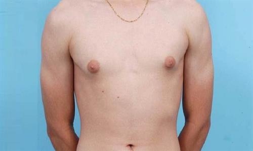 Gynecomastia Before Photo | Miami, FL | Baker Plastic Surgery