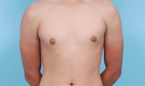 Gynecomastia After Photo | Miami, FL | Baker Plastic Surgery