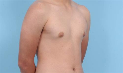 Gynecomastia After Photo | Miami, FL | Baker Plastic Surgery