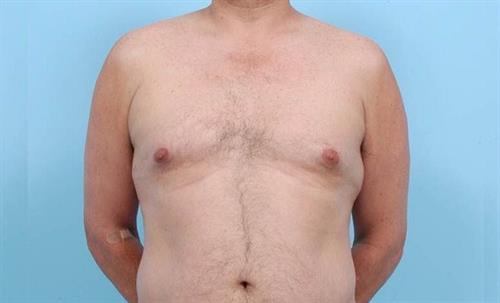 Gynecomastia Before Photo | Miami, FL | Baker Plastic Surgery