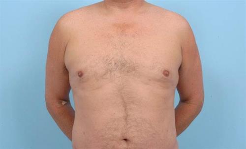 Gynecomastia After Photo | Miami, FL | Baker Plastic Surgery