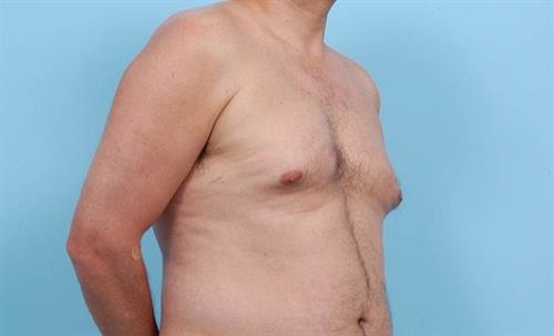 Gynecomastia Before Photo | Miami, FL | Baker Plastic Surgery