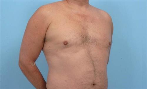 Gynecomastia After Photo | Miami, FL | Baker Plastic Surgery