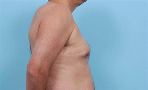 Gynecomastia Before Photo | Miami, FL | Baker Plastic Surgery