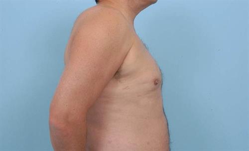 Gynecomastia After Photo | Miami, FL | Baker Plastic Surgery