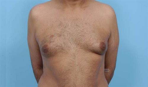 Gynecomastia Before Photo | Miami, FL | Baker Plastic Surgery