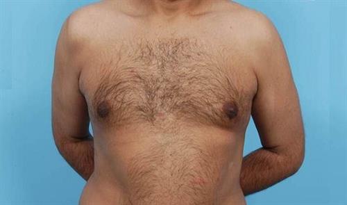 Gynecomastia After Photo | Miami, FL | Baker Plastic Surgery