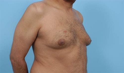 Gynecomastia Before Photo | Miami, FL | Baker Plastic Surgery