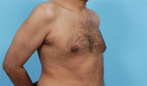 Gynecomastia After Photo | Miami, FL | Baker Plastic Surgery