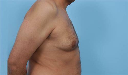 Gynecomastia Before Photo | Miami, FL | Baker Plastic Surgery