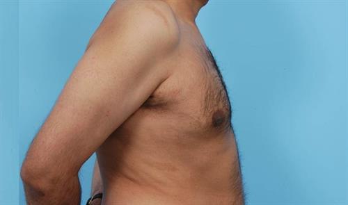 Gynecomastia After Photo | Miami, FL | Baker Plastic Surgery