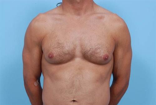 Gynecomastia Before Photo | Miami, FL | Baker Plastic Surgery