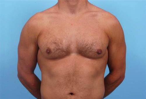 Gynecomastia After Photo | Miami, FL | Baker Plastic Surgery