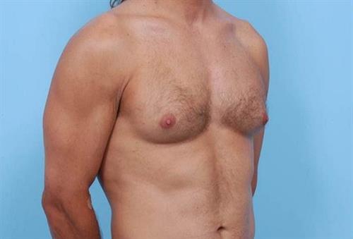 Gynecomastia Before Photo | Miami, FL | Baker Plastic Surgery