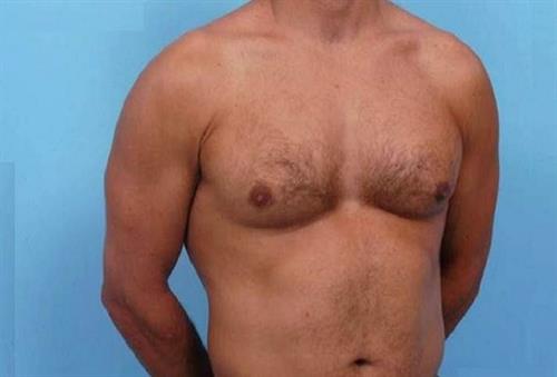 Gynecomastia After Photo | Miami, FL | Baker Plastic Surgery