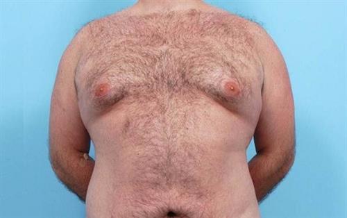 Gynecomastia Before Photo | Miami, FL | Baker Plastic Surgery