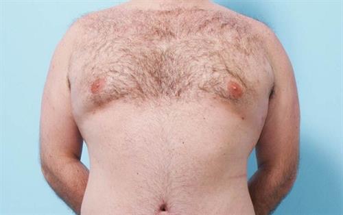 Gynecomastia After Photo | Miami, FL | Baker Plastic Surgery