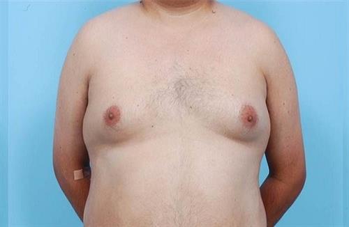 Gynecomastia Before Photo | Miami, FL | Baker Plastic Surgery