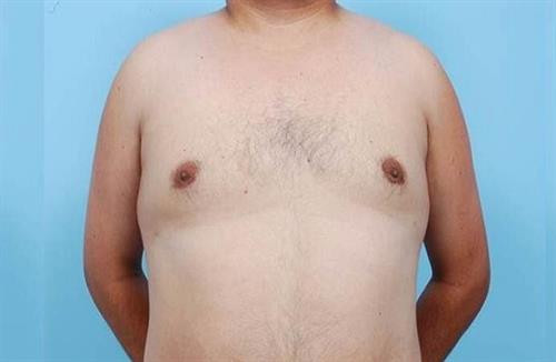 Gynecomastia After Photo | Miami, FL | Baker Plastic Surgery