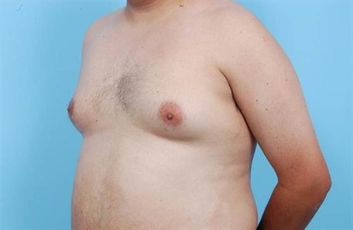 Gynecomastia Before Photo | Miami, FL | Baker Plastic Surgery