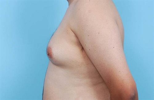 Gynecomastia Before Photo | Miami, FL | Baker Plastic Surgery