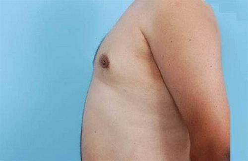 Gynecomastia After Photo | Miami, FL | Baker Plastic Surgery