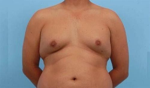 Gynecomastia Before Photo | Miami, FL | Baker Plastic Surgery