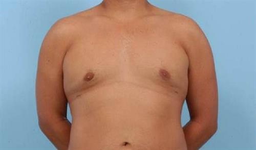 Gynecomastia After Photo | Miami, FL | Baker Plastic Surgery