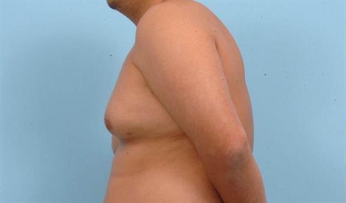 Gynecomastia Before Photo | Miami, FL | Baker Plastic Surgery